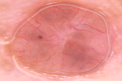 Diagnosi-dermoscopica.
Carinoma-basocellulare