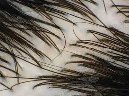 Tricoscopia dettaglio Tricoscopia dettaglio